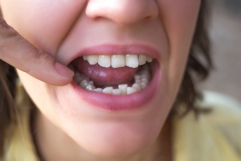 Struggling with Misaligned Teeth? Try Invisalign in El Dorado Hills