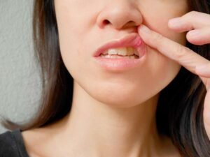 Laser Treatment for Mouth Sores: What to Expect at Mantena Dental